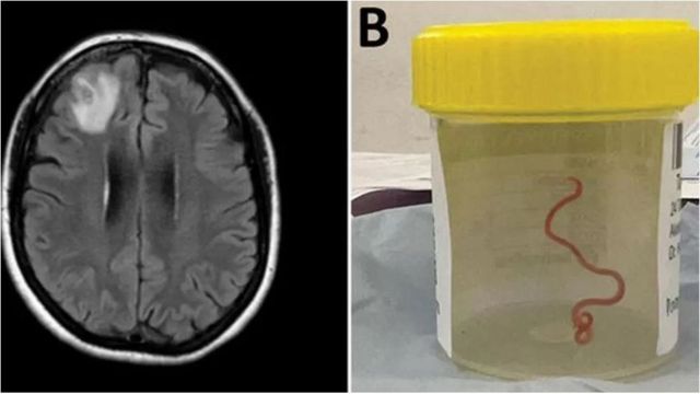 Un escáner cerebral y el gusano moviéndose en un frasco de muestras