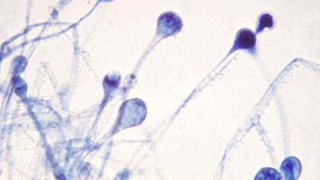 மியூகார்மைகோஸிஸ்