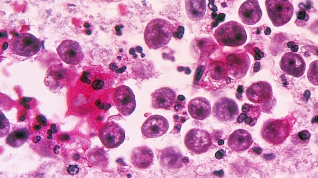 A microscopic image of a Naegleria fowleri amoeba infection