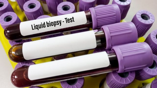 Des tubes de sang avec une étiquette portant la mention "biopsie liquide".