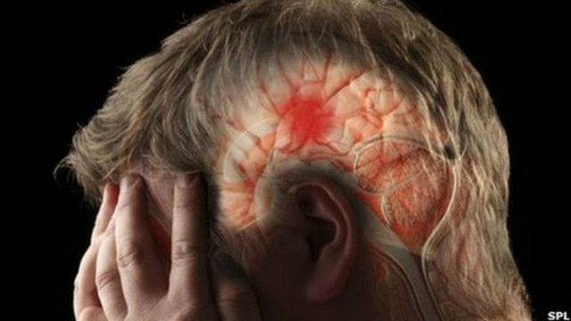 Imagem mesclada com ilustração mostra homem sofrendo um derrame cerebral
