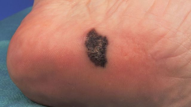 Melanoma lentiginoso acral en la planta del pie.
