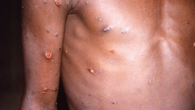Bras et torse d'un patient présentant des lésions cutanées dues au monkeypox. Photo d'archive
