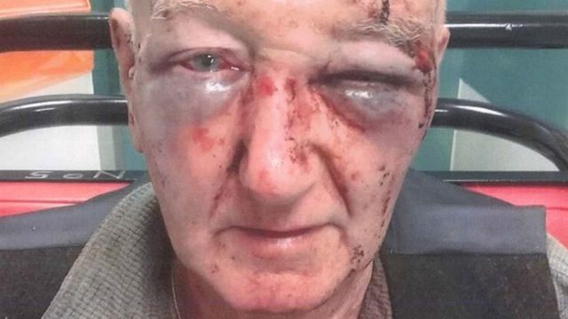Rosto de Laidlaw, de 70 anos, ficou desfigurado