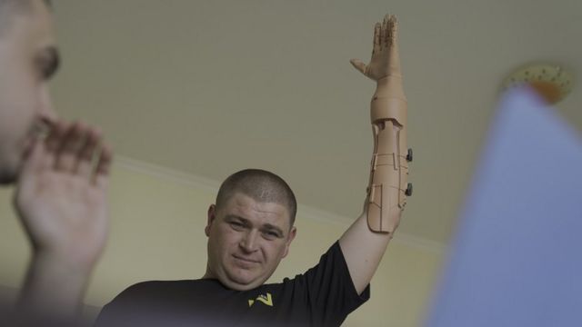 Юрій отримав найлегший у світі протез руки від компанії Unlimited Tomorrow