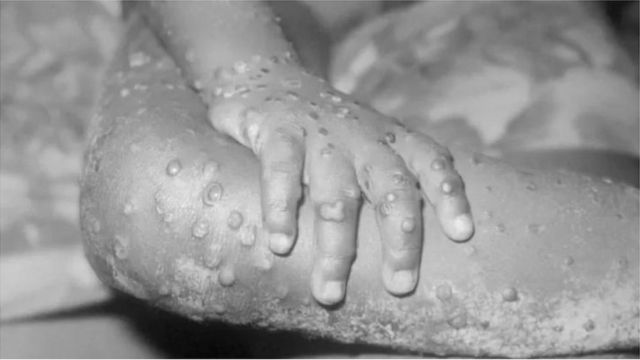 Symptoms of monkeypox include a rash that starts on the face and spreads throughout the body.