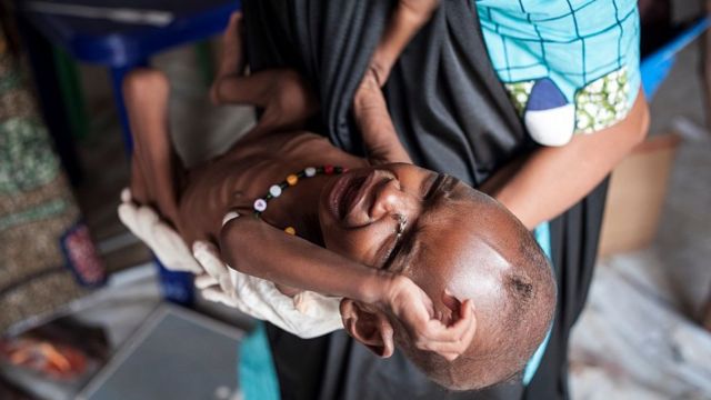 Malnutrition, Nigeria