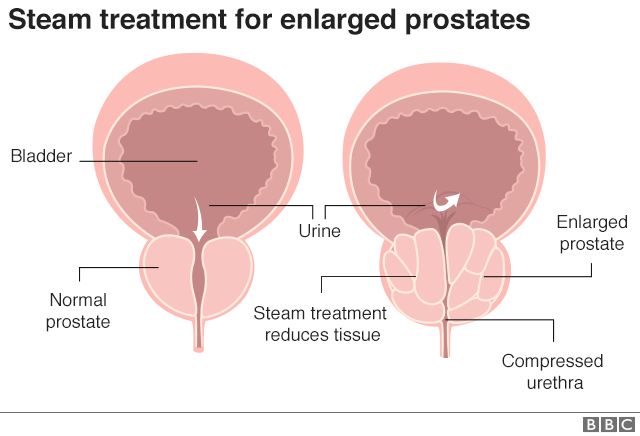 treatment enlarged prostate nhs)