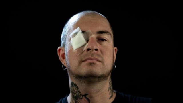 El cantante de Hacia La Victoria, Sergio "Totó" Concha, recibió un perdigón en el ojo derecho.