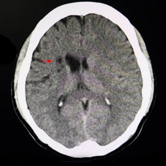 Una flecha roja señala un pequeño daño cerebral en una imagen de resonancia magnética (IRM)