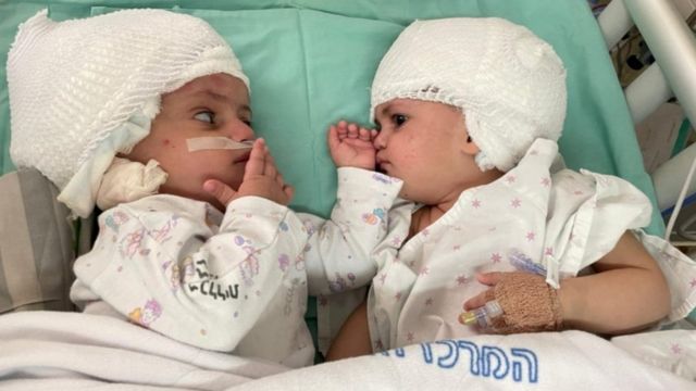Twins after the separation surgery