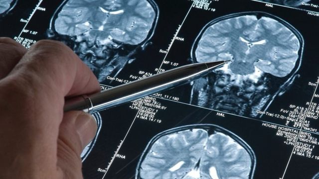 A pen pointing to scans of a brain.