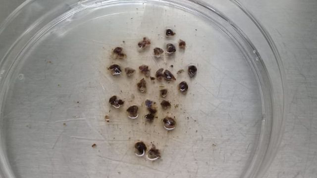 Trozos de tumor fresco de melanoma acral de un paciente mexicano