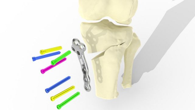 El implante conserva la articulación existente y puede usarse en una etapa más temprana de la artritis, antes de que sea necesario un reemplazo de rodilla.