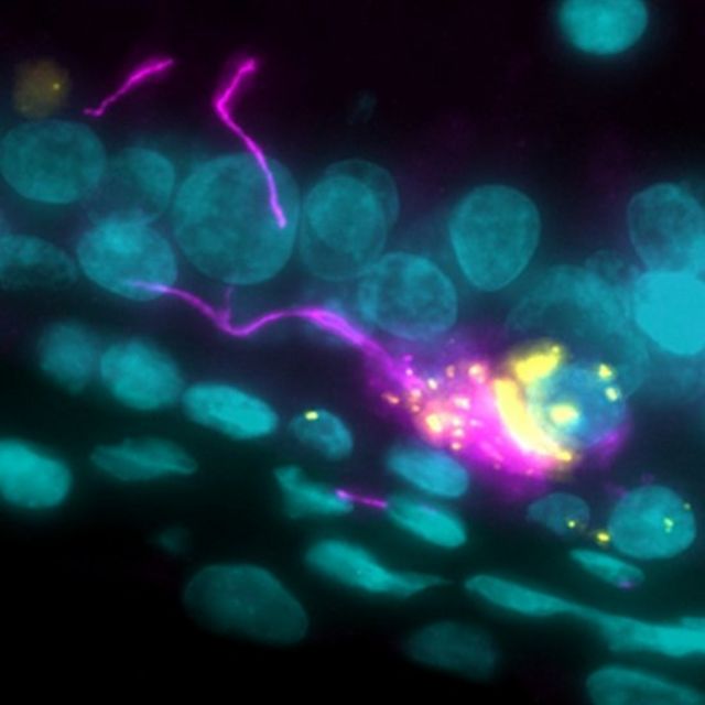 Imunoflorescência mostra Sars-Cov-2 (amarelo) afetando um neurônio (rosa)