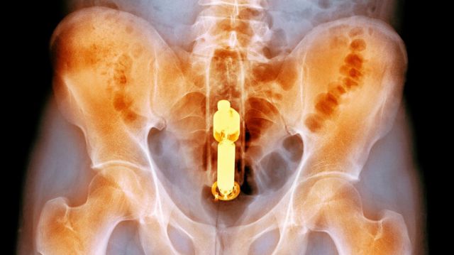 Una radiografía muestra un objeto cilíndrico dentro del recto de un hombre