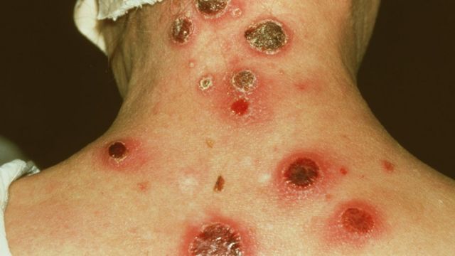 Llagas en la piel causadas por la sífilis