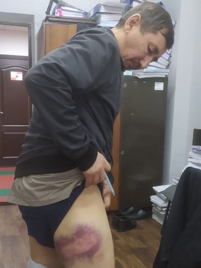 Muratbek Yesengazy bacağındaki izleri gösteriyor