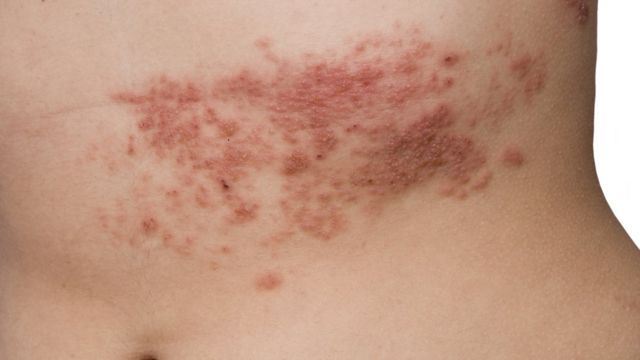 hpv e herpes