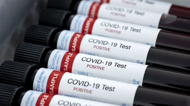 Coronavirus: la nueva prueba de anticuerpos que es "crucial" para hacer  frente a pandemia del covid-19 - BBC News Mundo