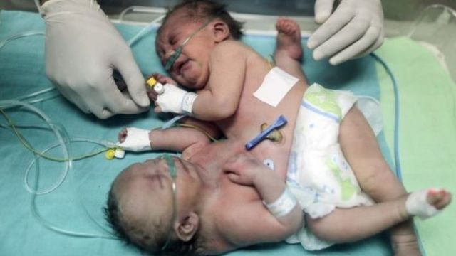 أطباء سعوديون ينجحون في فصل توأم سيامي فلسطيني رغم وفاة إحداهما Bbc News عربي