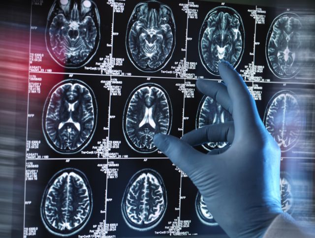 Un médico revisa unas tomografías del cerebro.