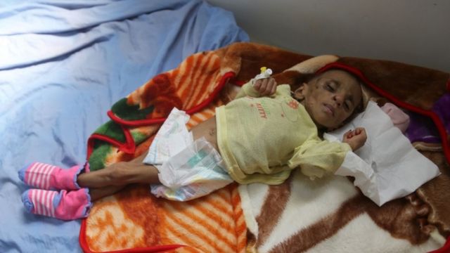 طفل يمني يكابد وباء الكوليرا