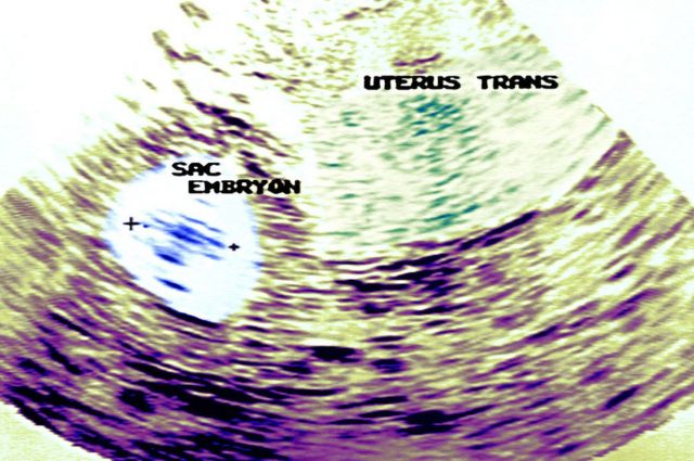 Imagem de ultrassom de uma mulher grávida