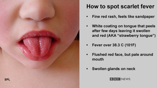 Scarlet fever outbreak fears: What are the symptoms, what treatment is  available and how is it spread?, The Independent