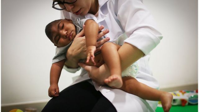 Una doctora con un niño con microcefalia