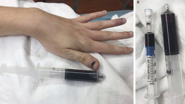 Imagen de las uñas y una extracción de sangre de la paciente.