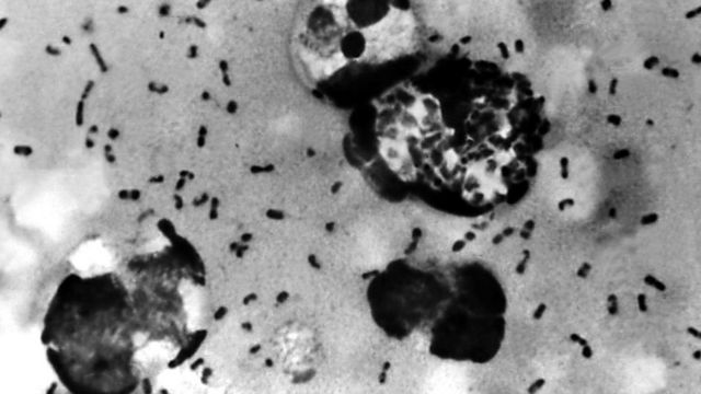 A bubonic plague smear, prepared from a lymph removed from an adenopathic lymph node