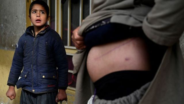 نور الدين، الذي باع كليته لجمع الأموال لعائلته، يظهر الندوب من العملية بجوار ابنه جافيد في منزلهم في هرات، أفغانستان