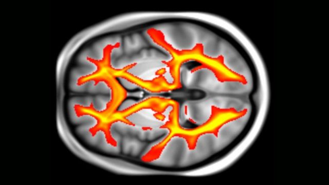 ภาพสแกน MRI แสดงให้เห็นวิถี (pathway) ที่เชื่อมต่อกันระหว่างเนื้อสีขาวในสมองส่วนต่าง ๆ