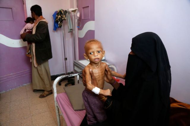 طفل يمني يعاني من سوء التغذية في قسم سوء التغذية بمستشفى السبعين، حيث يتلقى العلاج في 13 فبراير /شباط 2021 بصنعاء.