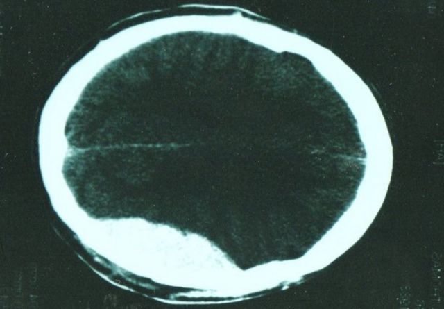 Tomografia cerebral de Thomas Leeds mostrando sangramento
