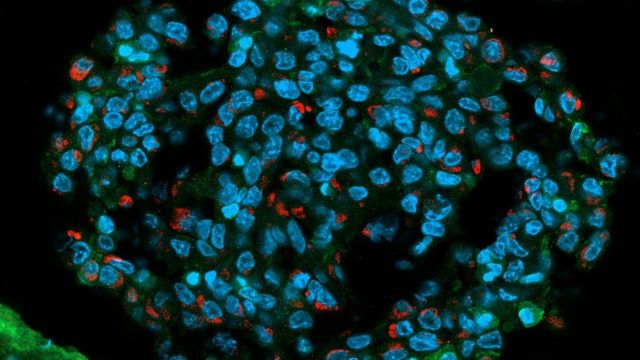 Radiografia mostra ação do zika contra tumores em cérebros de camundongos