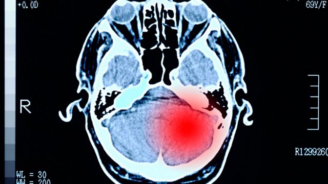 Escáner mostrando daños cerebrales causados por un tumor.