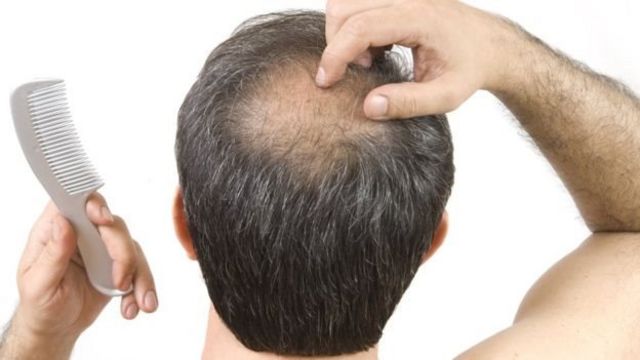 脫髮人士福音：新藥或有望治癒「禿頭」煩惱- BBC News 中文