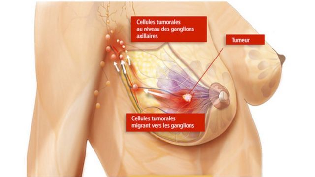 Anatomie du sein - Cancer du sein