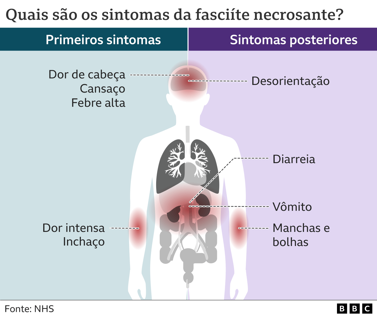 Infographic shows symptoms of necrotizing fasciitis
