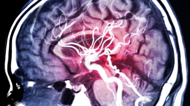 Imagen de resonancia magnética (IRM) del cerebro