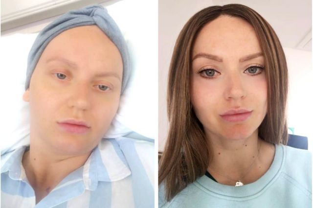 Dos fotos de Laura durante su tratamiento contra el cáncer. A la izquierda ella sin apenas cejas y pestañas, con la cabeza cubierta. A la derecha, maquillada y con las cejas tatuadas.