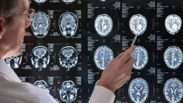brain
