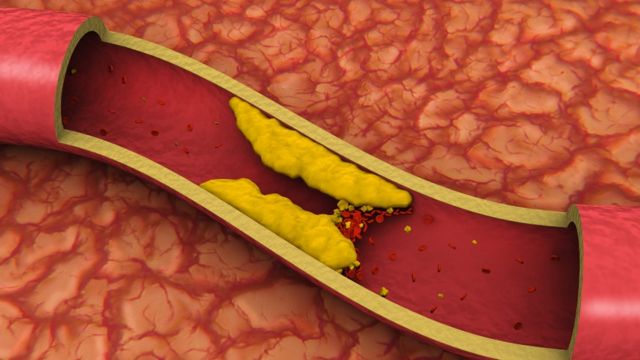 Ilustração de um vaso sanguíneo obstruído por gordura