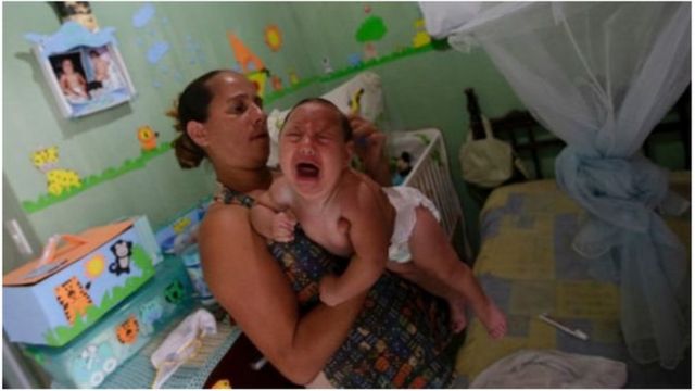 Nouveau-né atteint du virus Zika