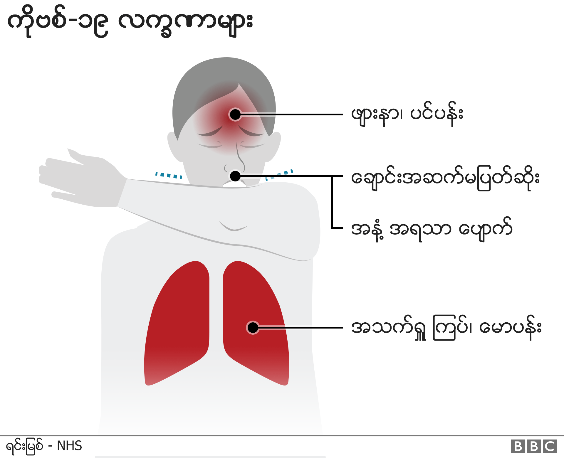 ကိုဗစ်လက္ခဏာများ