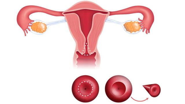 கருப்பை வாய்