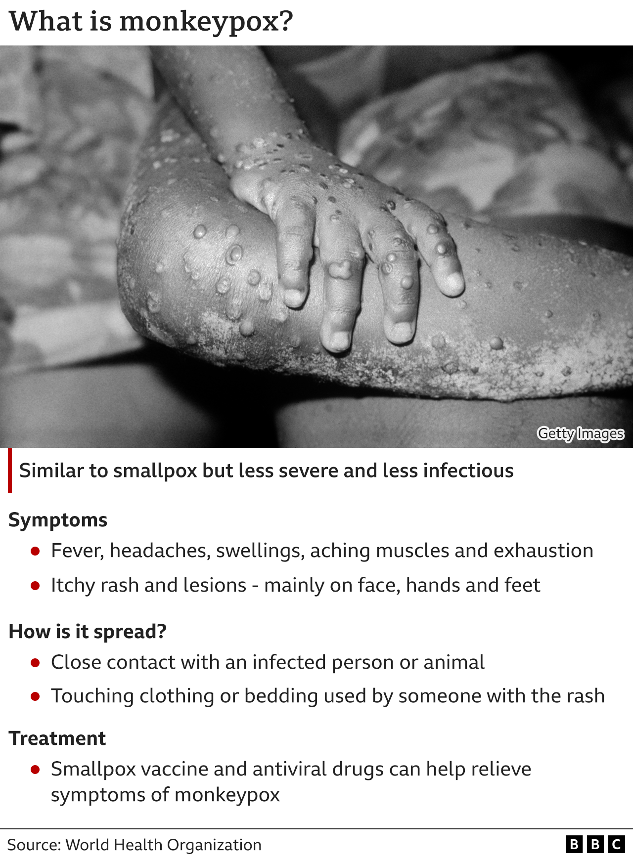What Is Monkeypox: Symptoms, Pictures, and Treatment