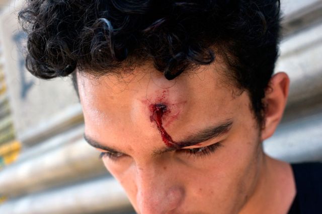 Un joven con una herida en la frente.